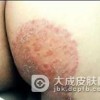 体癣注意的饮食禁忌是什么