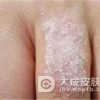 体癣日常生活应该注意什么