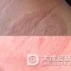 体癣该如何护理呢