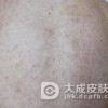 毛囊角化症症状