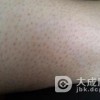 详谈毛囊角化症症状与治疗