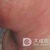 传染性湿疹样皮炎长什么样？