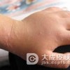 认识传染性湿疹样皮炎
