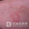 传染性湿疹样皮炎的症状表现具体是什么