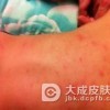 传染性湿疹样皮炎的诊断
