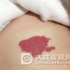 婴幼儿血管瘤的危害严重吗