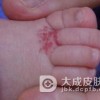 医生告诉你毛细血管瘤危害