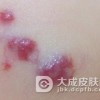 混合型血管瘤是如何形成的