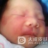 冬季如何护理血管瘤患者