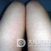 毛囊角化能治好吗？
