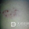 梅毒会引发艾滋病吗