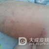 艾滋病的两大传播方法