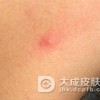 艾滋病的3大传播途径