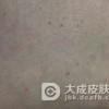 关于艾滋病的治疗方法有哪些