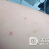 美发现黄芪可治疗艾滋病