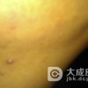 脂溢性皮炎与艾滋病有联系吗