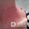 得了遗传过敏性皮炎要注意什么