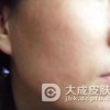 患了遗传过敏性皮炎 治疗加护理康复快