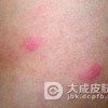 遗传出现过敏性皮炎该怎么护理