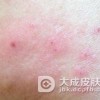 遗传过敏性皮炎做好皮肤护理很重要