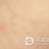 做好过敏性皮炎的保健方法是什么