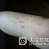 过敏性皮炎处理要谨慎