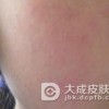 遗传过敏性皮炎日常要注意什么