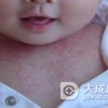 夏季皮炎应该如何防治