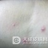 梅毒的危害到底有多大