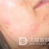 遗传过敏性皮炎患者洗澡时注意些什么？