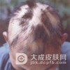 导致头发斑秃的原因