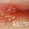 带状疱疹如何自我检查