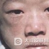 哪些因素会导致皮肌炎的发生
