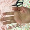掌跖脓疱病有什么相似疾病