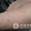 宝宝得了花斑癣怎么办