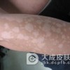 患花斑癣该要怎么办