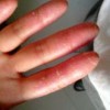 掌趾脓疱的病因是什么