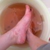脓疱型银屑病遗传吗