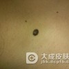 色素痣形成的具体原因