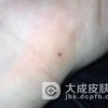 形成色素痣的原因是什么