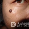 引发黑色素痣的原因是什么