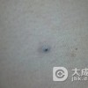 色素痣是否需要治疗