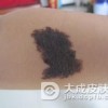 黑色素痣采用激光治疗效果如何