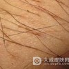 得了阴虱病后该注意哪些呢