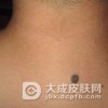 黑色素细胞痣如何治疗
