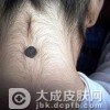 哪些色素痣宜手术治疗