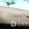 预防脂肪瘤心情很关键