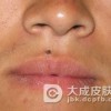 色素痣恶变的症状表现