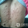 介绍脂肪瘤预防的小技巧