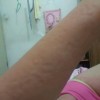 预防慢性荨麻疹应从日常做起
